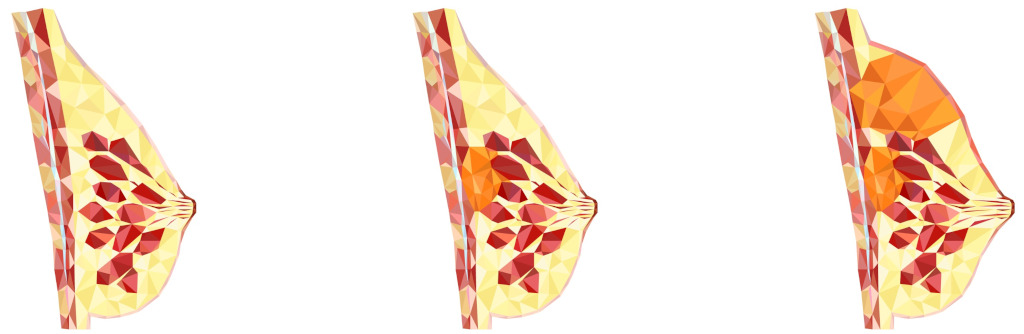 Ketogene antikankervoeding