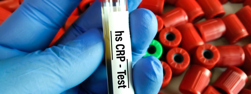 Inflamatie gevaarlijker dan cholesterol