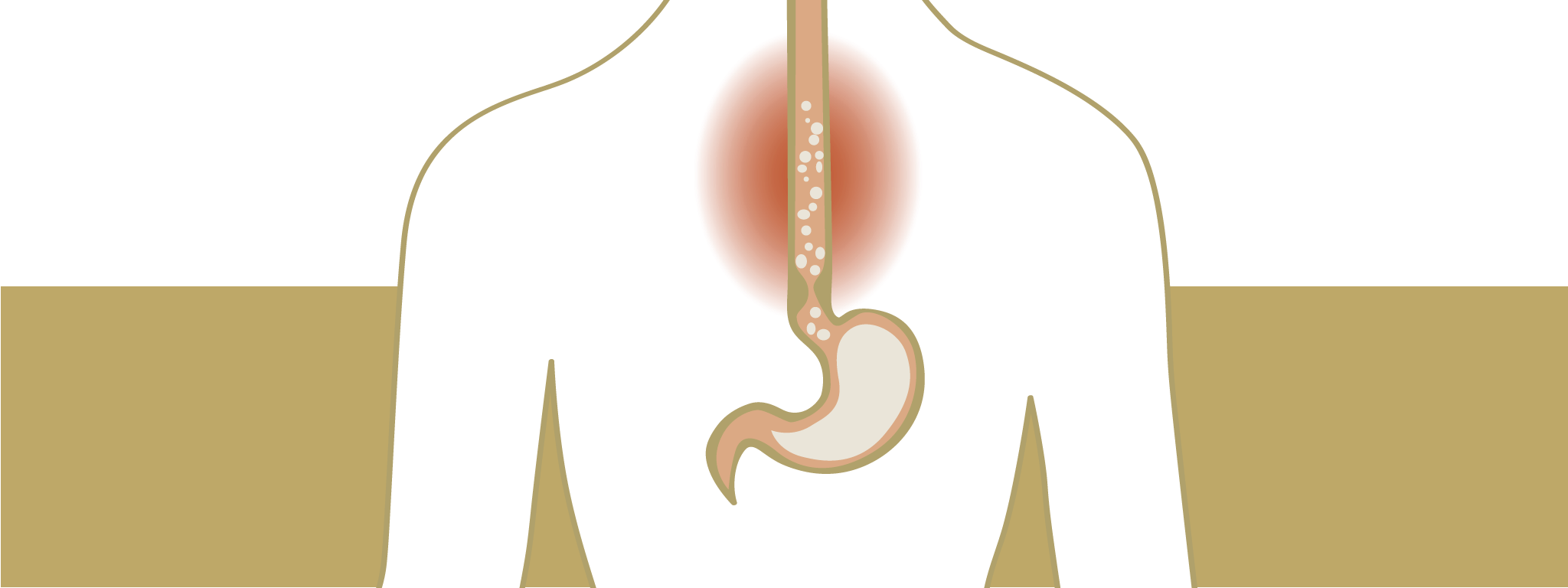 Medicatie tegen overgewicht veroorzaakt reflux