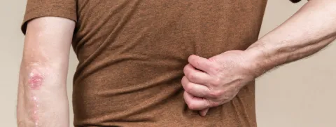 Psoriasis, hart- en vaatziekten en trombose