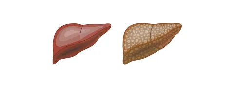 Beweging tegen vette lever