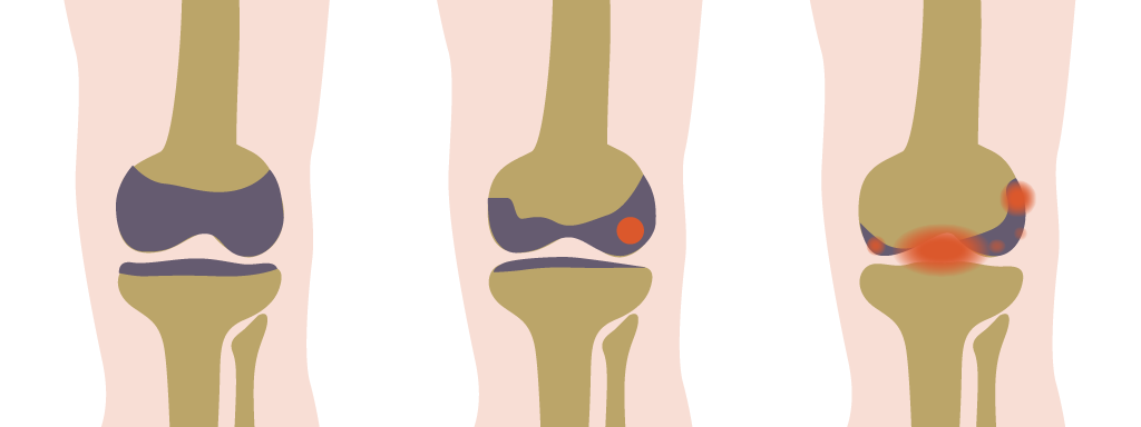 Artrose