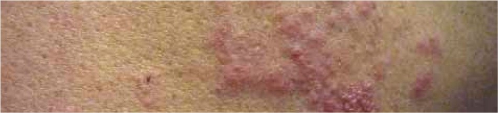 Herpes zoster Herpes zoster