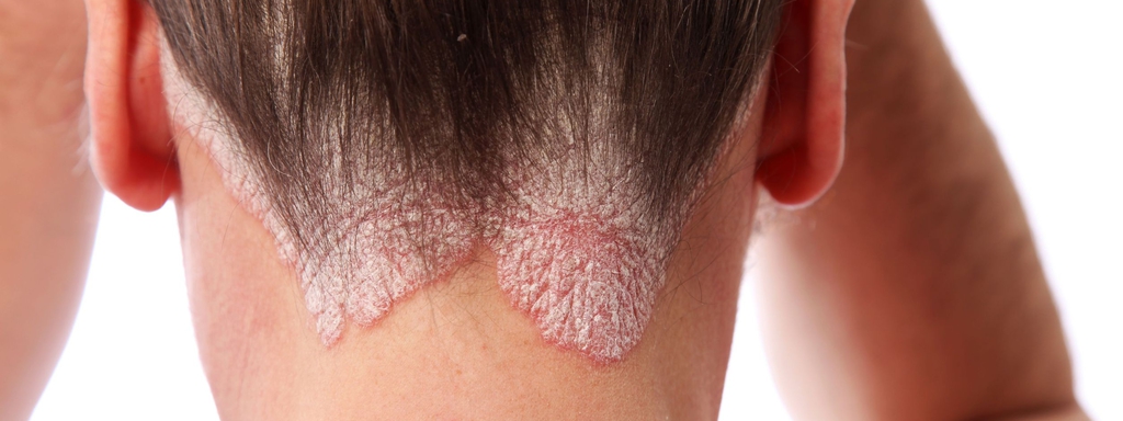 Psoriasis, voeding & fytotherapie Psoriasis, voeding & fytotherapie