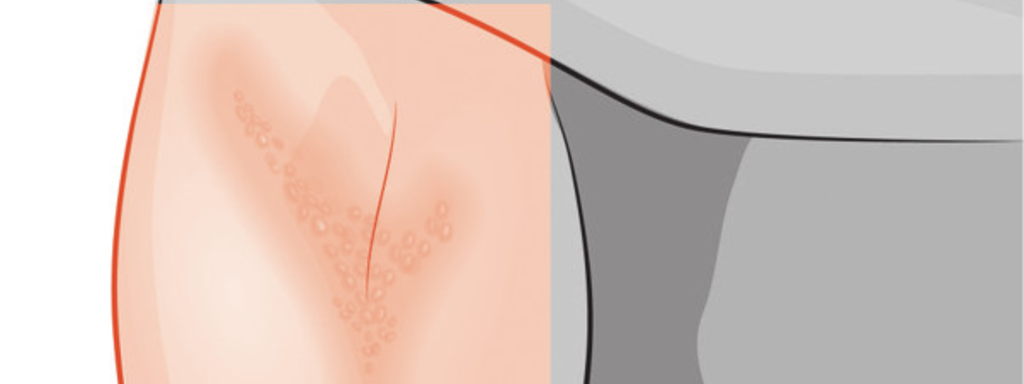 Eczeem of atopische dermatitis Eczeem