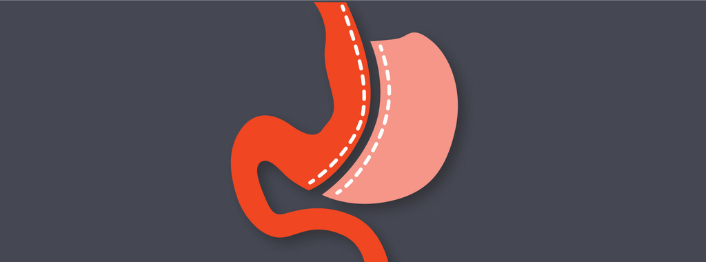 Voor- en nadelen van metabole chirurgie Voor- en nadelen van metabole chirurgie