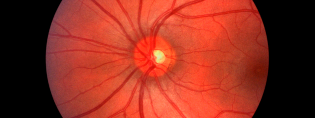 Retinopathie