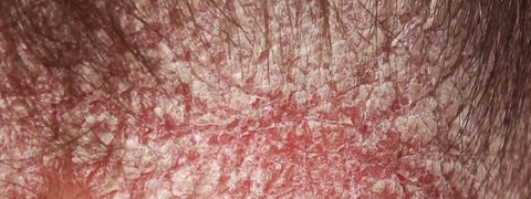 Psoriasis, voeding & fytotherapie