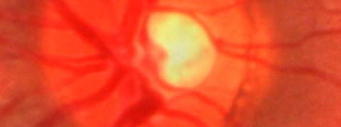 Retinopathie
