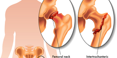 Osteoporose