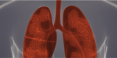 Voeding en longfibrose