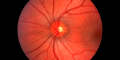 Retinopathie