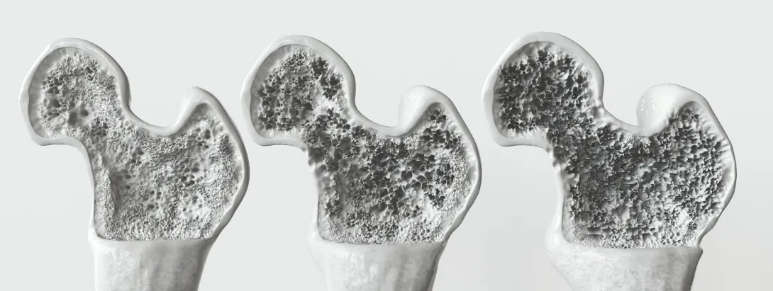 Zwakke botten vs dementie